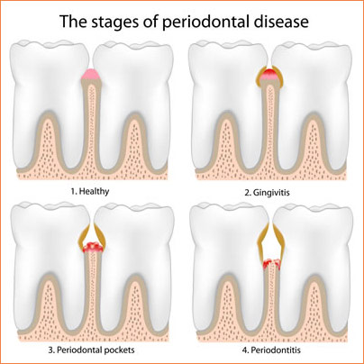 Periodontics Disease
